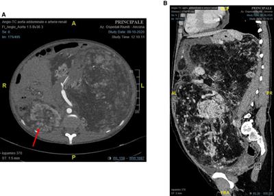 Case report: A hybrid technique for a safe nephrectomy in a giant kidney angiomyolipoma